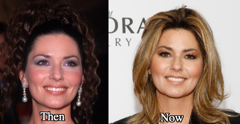 Shania Twain ultherapy before and after