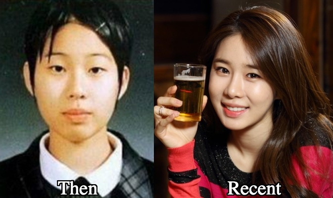 Yoo In Na Nose Job Before and after