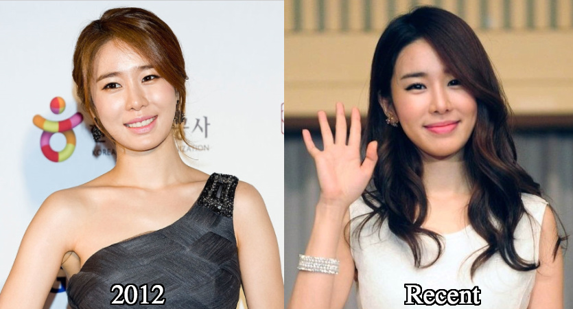 Yoo In Na Plastic surgery before and after photos