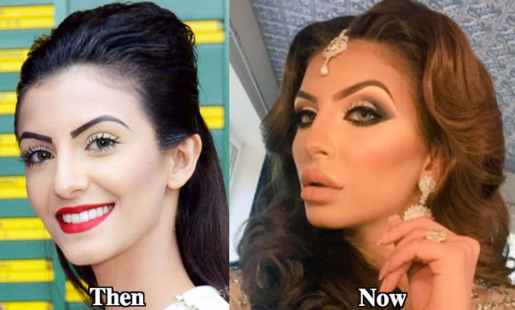 Faryal Makhdoom cheek augmentation fillers before and after photos