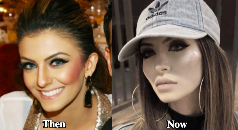 Faryal Makhdoom lip fillers before and after photos