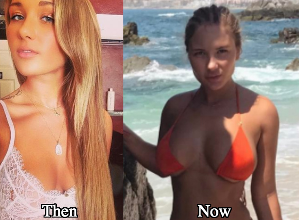 Niykee Heaton breast augmentation before and after