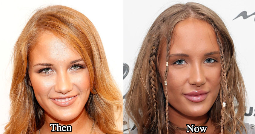 Niykee heaton botox injections before and after