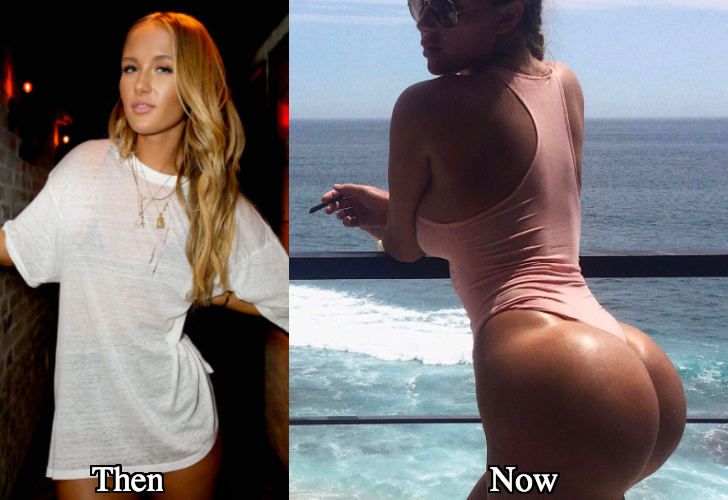 Niykee heaton butt augmentation lift before and after