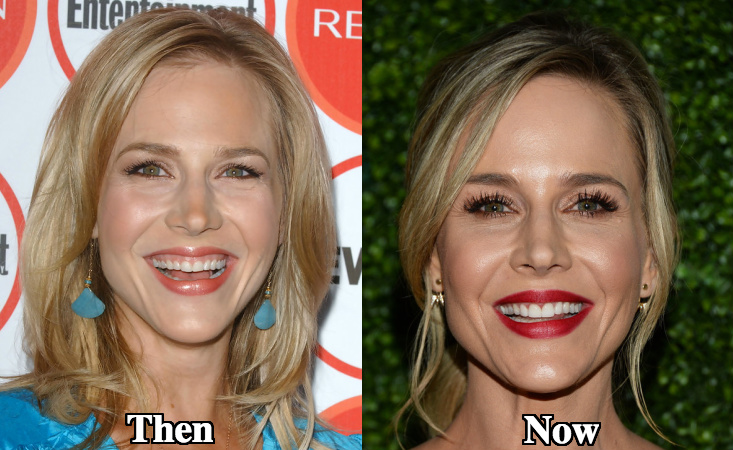 Julie Benz facial fillers before and after photos