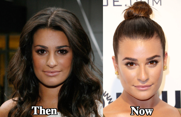 Lea Michele Rhinoplasty before and after photos