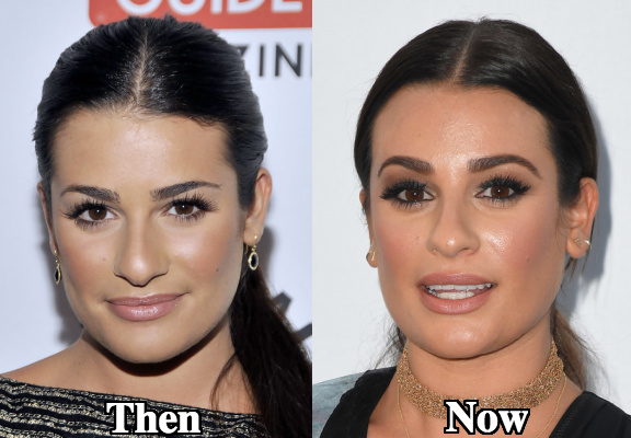 Lea Michele nose tip surgery