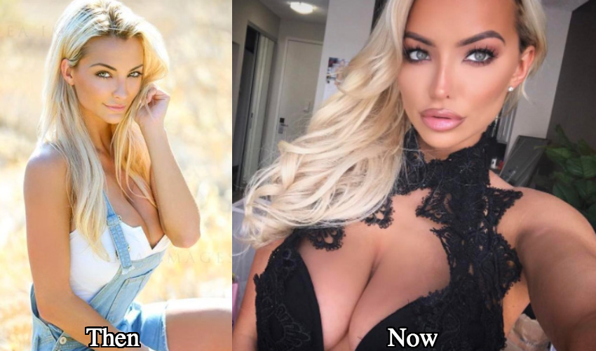 Lindsey Pelas lip fillers before and after photos
