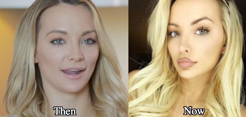 Lindsey Pelas lip fillers injections before and after