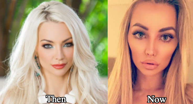 Lindsey Pelas rhinoplasty before and after