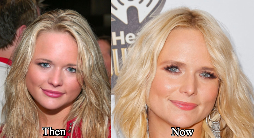 Miranda Lambert botox injections before and after photos
