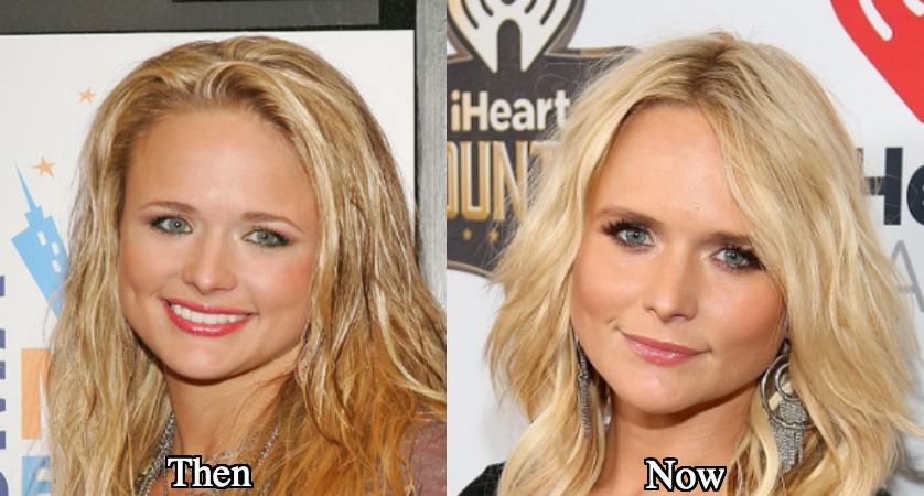 Miranda Lambert botox jabs before and after photos