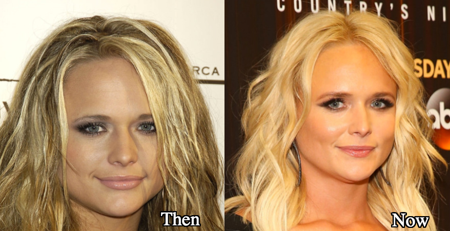 Miranda Lambert nose job before and after photos