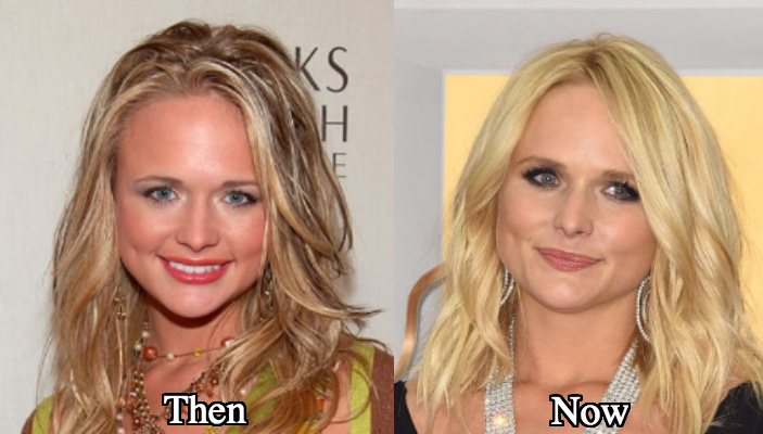 Miranda Lambert nose job before and after pictures