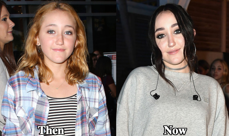 Noah Cyrus Cheek Fillers before and after photos