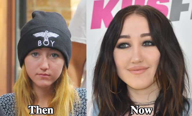 Noah Cyrus Chin implant surgery before and after
