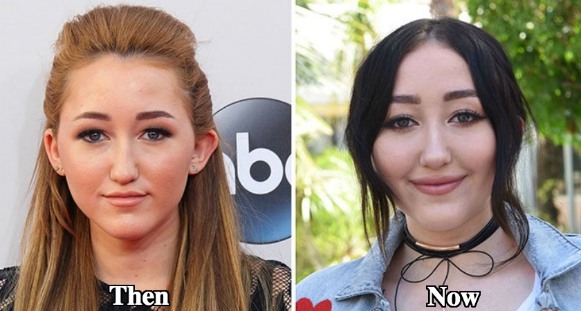 Noah Cyrus Plastic Surgery before and after photos