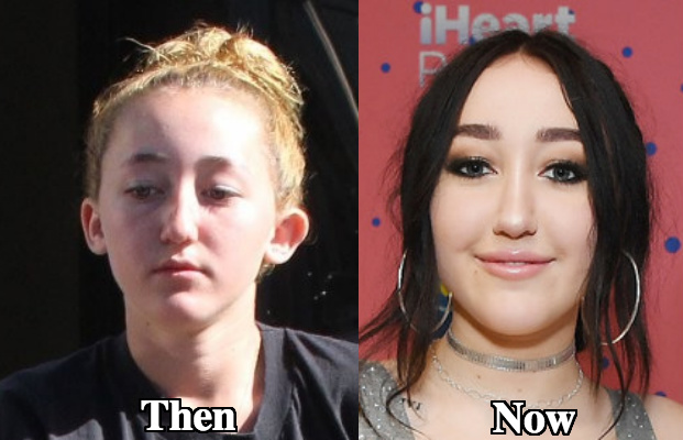 Noah Cyrus botox before and after