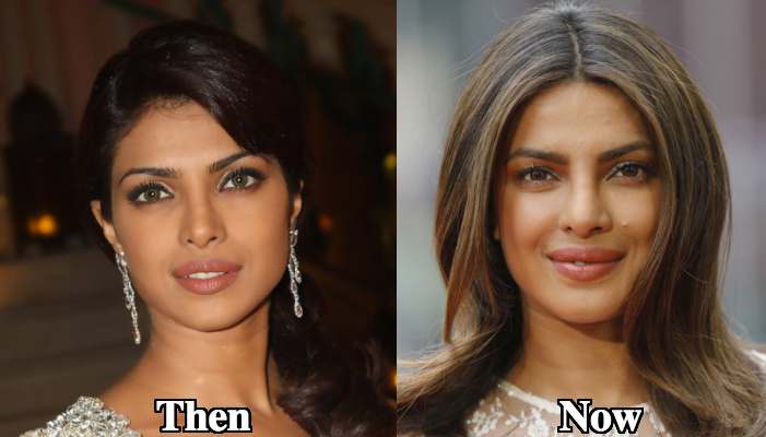 Priyanka Chopra botox 2 before and after photos
