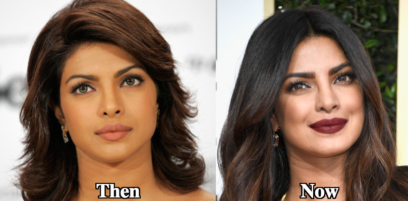 Priyanka Chopra botox before and after photos