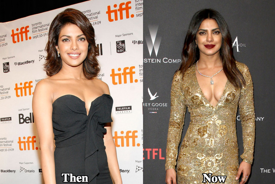 Priyanka Chopra breast augmentation before and after