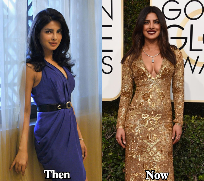 Priyanka Chopra breast implants size before and after