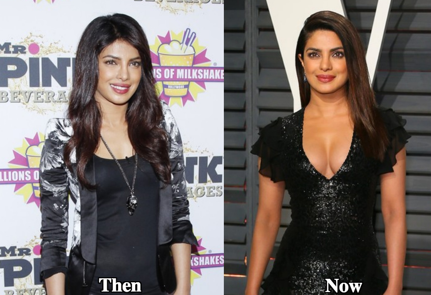 Priyanka Chopra breast implants surgery before and after