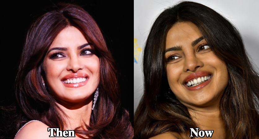 Priyanka Chopra lip fillers before and after photos