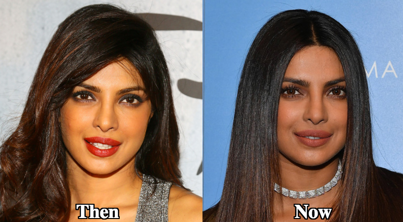 Priyanka Chopra lip fillers before and after