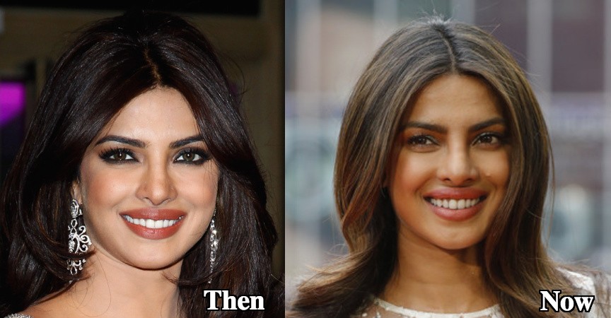 Priyanka Chopra nose job before and after photos