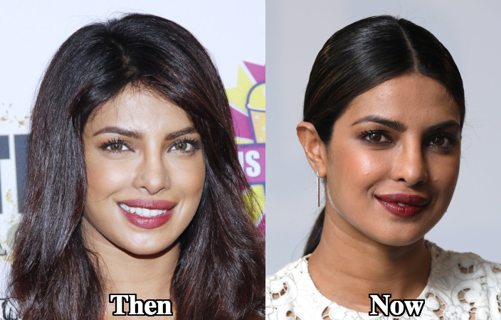 Priyanka Chopra rhinoplasty before and after