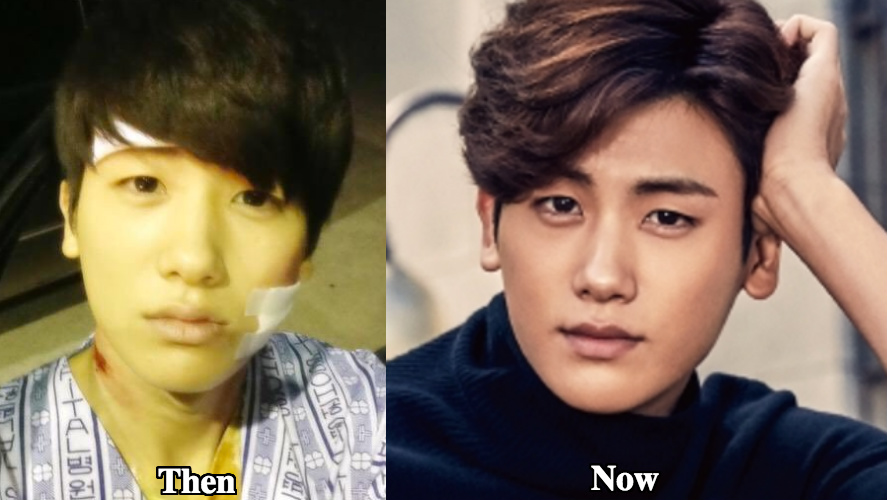 Park Hyung Sik eyelid surgery before and after photos