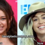 Miley Cyrus Teeth – Did Miley Cyrus Fix Her Teeth?
