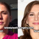 Ana Kasparian Nose Job Plastic Surgery Rumors – True or False?