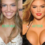 Kate Upton Plastic Surgery Before and After