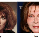 Lee Grant Plastic Surgery Before And After