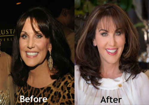 Robin-McGraw-Plastic-Surgery - Latest Plastic Surgery Gossip And News ...