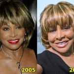 Tina Turner Plastic Surgery Before And After