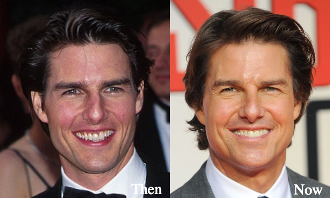 Tom Cruise Plastic Surgery Before And After Lovely Su - vrogue.co