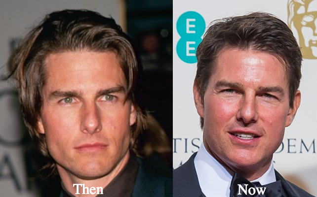 Tom Cruise Jaw Surgery.