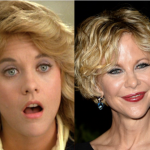 Meg Ryan Plastic Surgery – Before and After Photos