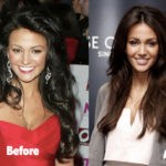 Michelle Keegan Before and After Plastic Surgery Lip Fillers