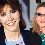 Carrie Fisher Plastic Surgery Before and After Photos