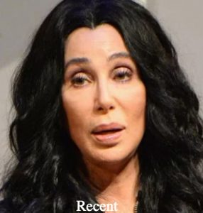 Cher Plastic Surgery Before and After Photos