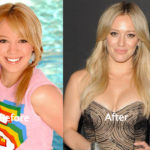 Hilary Duff Plastic Surgery Before and After Photos