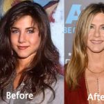 Jennifer Aniston Plastic Surgery Before and After Photos