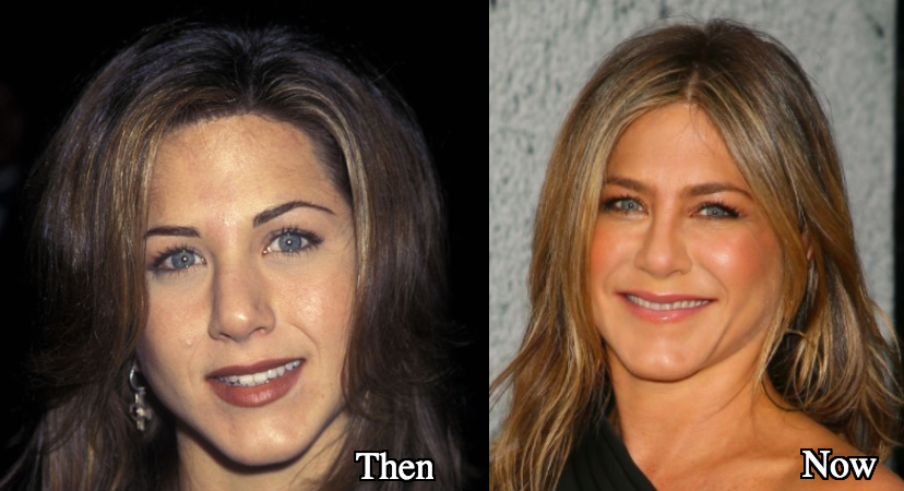 Jennifer Aniston Plastic Surgery - Use of Botox and Fillers.