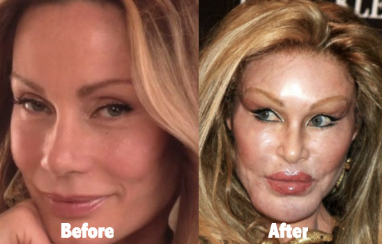 One of the most mentioned plastic surgery disasters, Jocelyn Wildenstein, a...