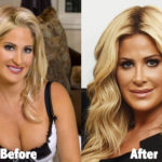 Kim Zolciak Plastic Surgery Before and After Photos