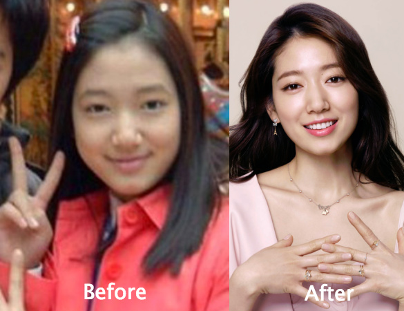 Park Shin Hye Plastic Surgery Before and After Photos.